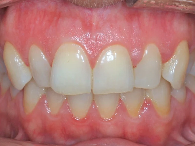 caso ortodoncia invisible Toro Mattozzi