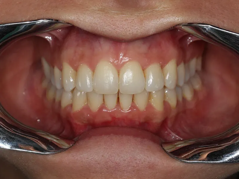 caso2 ortodoncia invisible Toro Mattozzi